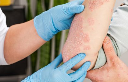 Managing Psoriasis Flare-Ups: Tips for Calgary Seniors