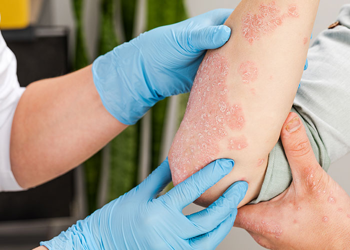 Managing Psoriasis Flare-Ups: Tips for Calgary Seniors