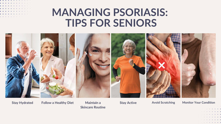 managing psoriasis